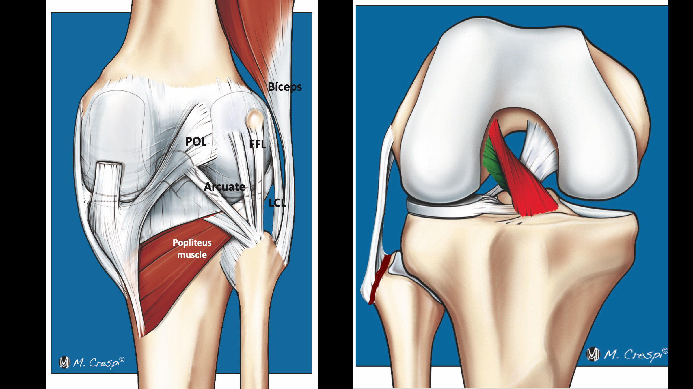 Figure 4 for case Isolated distal detachment of the lateral collateral ligament and biceps femoris tendon